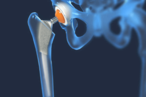 Quando Considerar a Cirurgia de Quadril: Sinais e Sintomas que Indicam a Necessidade de uma Prótese de Quadril